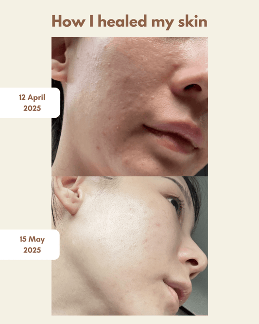 How I Healed My Skin: Overcoming Acne and Rebuilding My Skin Barrier Naturally - PIXIEPAX